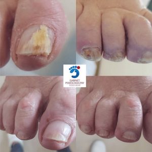 Podolog Bielsko-Biała Gabinet Podologiczny